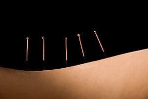How Does Acupuncture Work?