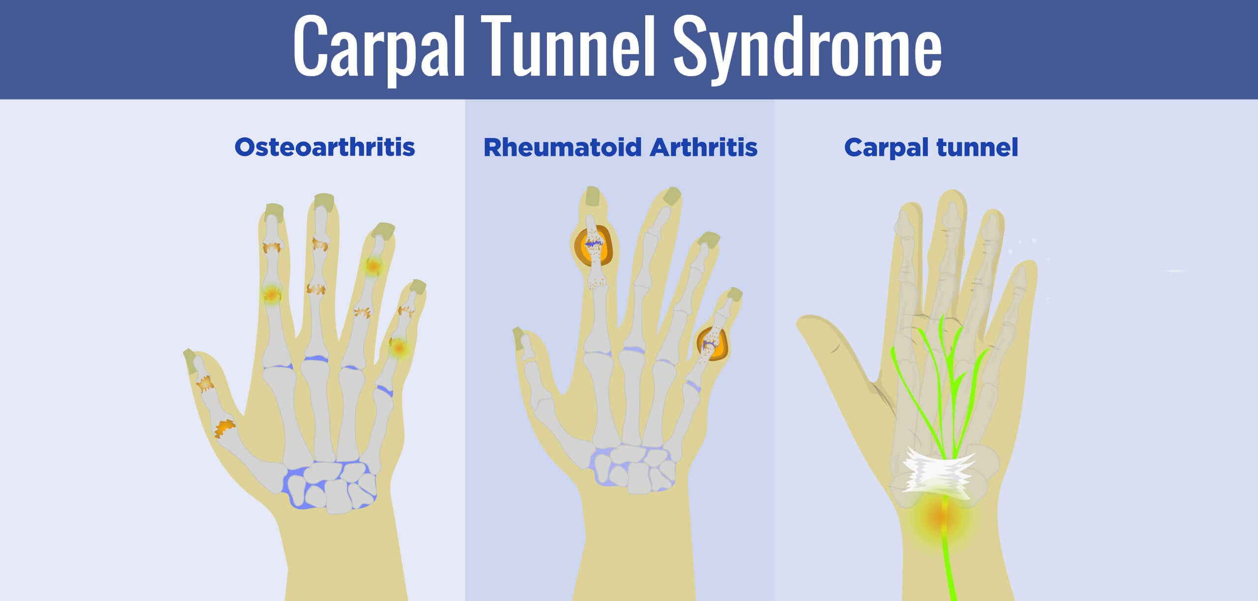 carpal tunnel syndrome treatment near gaithersburg md