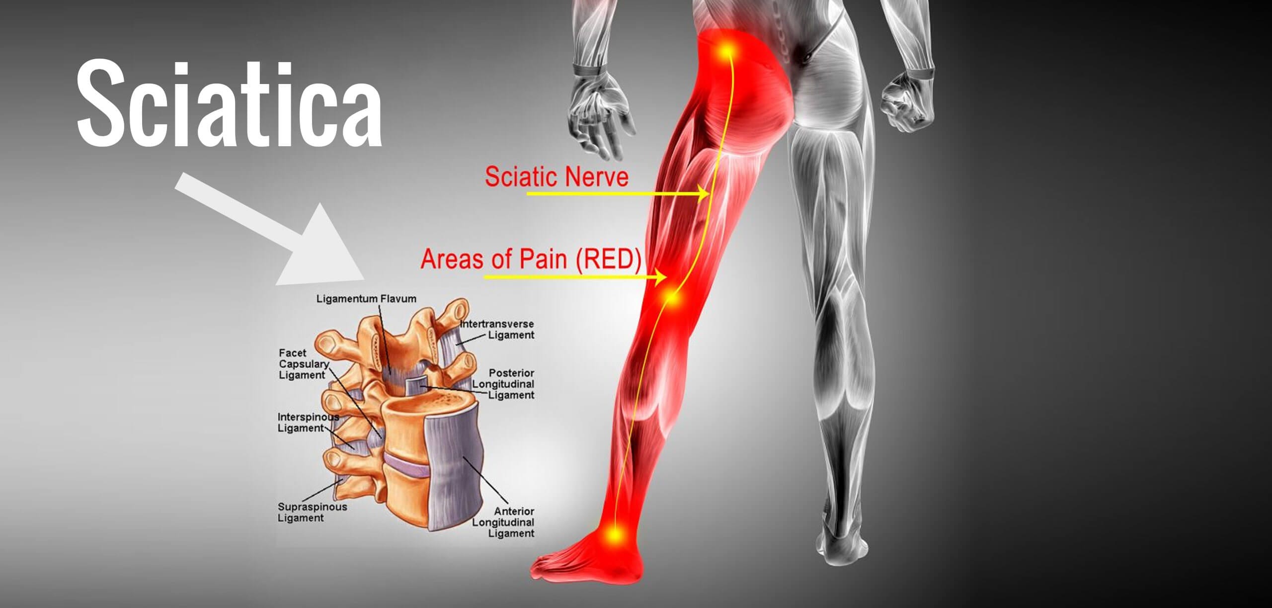 sciatica pain relief md